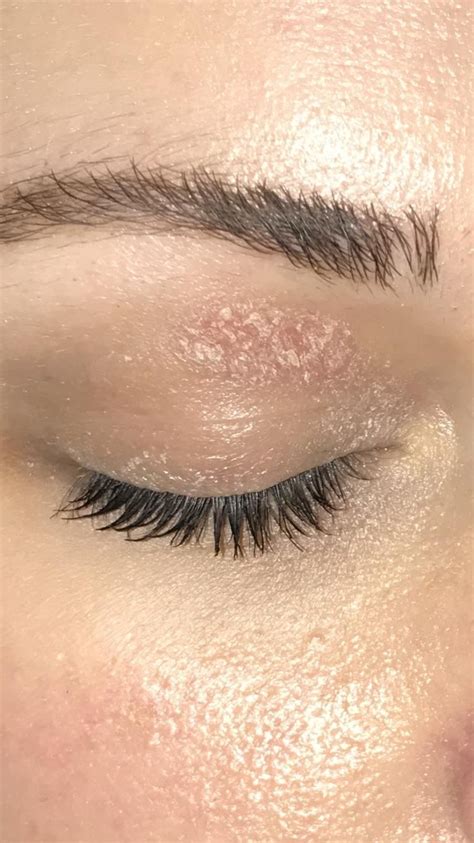 [Skin Concern] What is this patch on my eyelid? How do I treat it? It's dry and stings ...