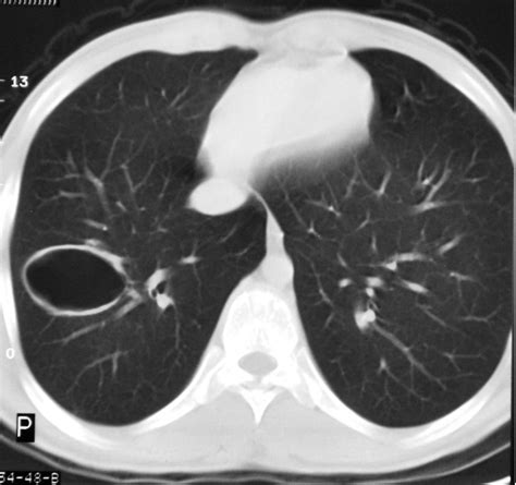 Pulmonary Cyst