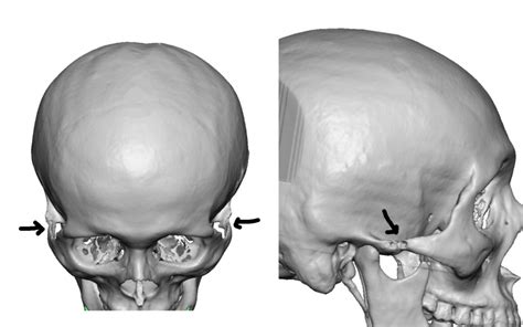 The Posterior Zygomatic Arch Osteotomy in Cheekbone Reduction (Facial ...