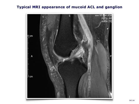 Mucoid ACL Degeneration