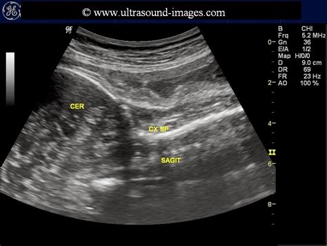 Ultrasound imaging: prominent fetal cisterna magna or more ominous?