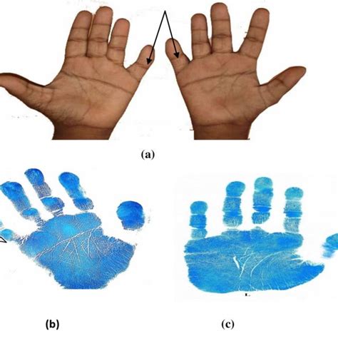 (a) Single flexion crease in little finger in both hand of Down ...