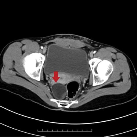 Pelvic CT scan revealed a cystic lesion at the pararectal region with... | Download Scientific ...