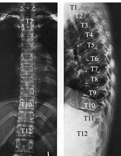 Thoracic spine Flashcards | Quizlet