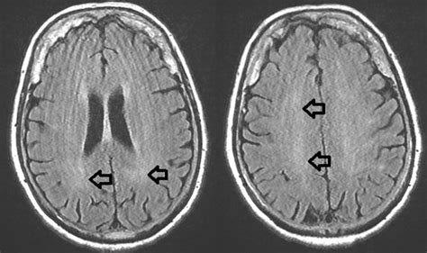 Patient#3’s brain MRI performed at 16 days from symptoms onset, showing... | Download Scientific ...