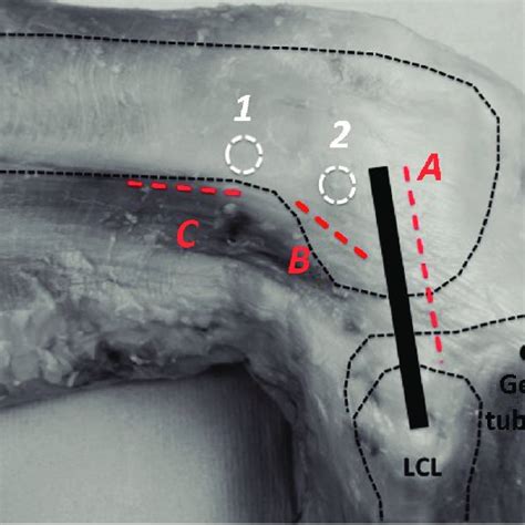 Response to a 90-N anterior drawer force for (1) intact, (2) anterior... | Download Scientific ...