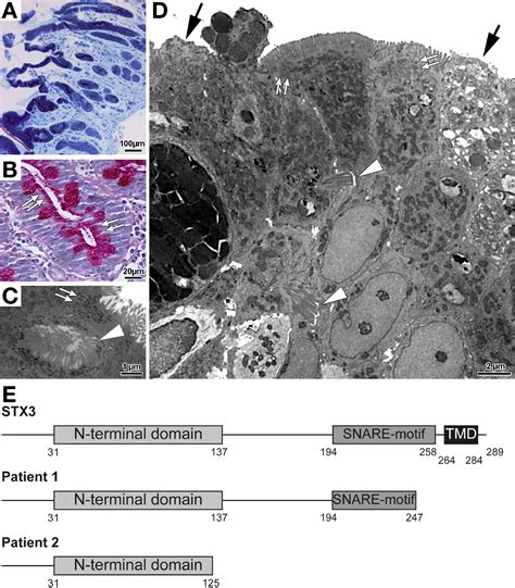 Loss of Syntaxin 3 Causes Variant Microvillus Inclusion Disease - Gastroenterology