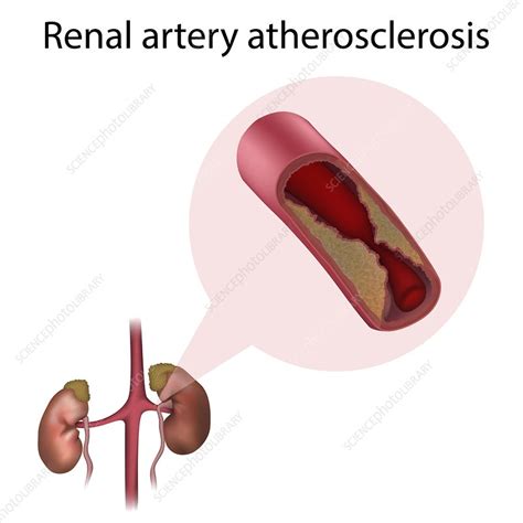 Renal artery atherosclerosis, illustration - Stock Image - F027/1963 - Science Photo Library