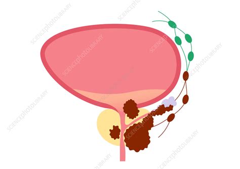 Prostate cancer, illustration - Stock Image - F036/3673 - Science Photo Library