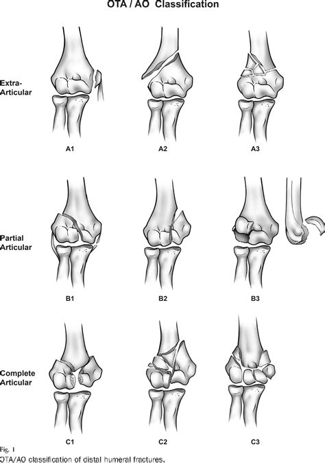 Figure 1 from CurrentConceptsReview Distal Humeral Fractures in Adults ...