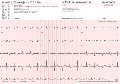 Right bundle branch block - ECG Tutorial