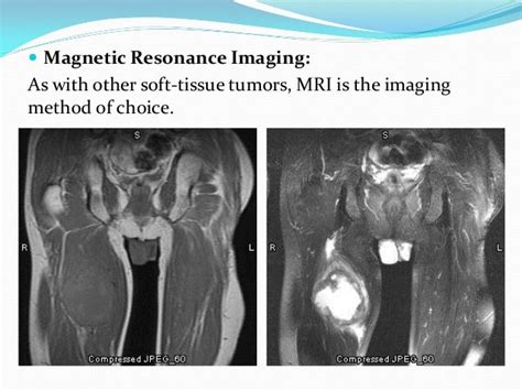 Malignant fibrous histiocytoma, Undifferntiated pleomorphic sarcoma