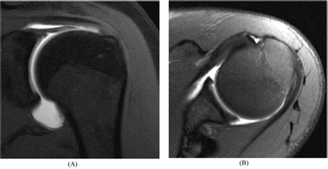 MR Imaging of SLAP Lesions