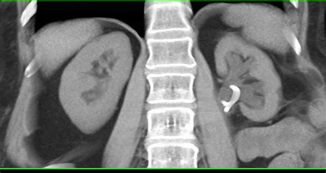 Thinning of the Cortex of the Left Kidney - Kidney Case Studies - CTisus CT Scanning