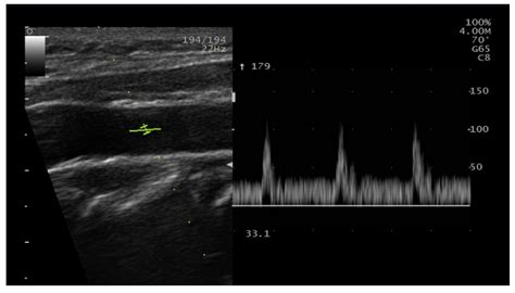 Arterial Duplex Ultrasound | Download Scientific Diagram