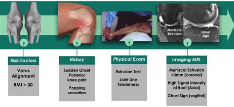 Meniscal root tears: a silent epidemic | British Journal of Sports Medicine