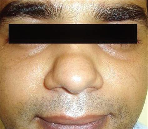 Appraisal of transverse nasal groove: A study - Indian Journal of Dermatology, Venereology and ...