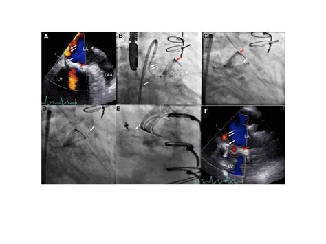 HVS - Percutaneous Transcatheter Repair of Bioprosthetic Mitral Valve Dehiscence and Associated ...