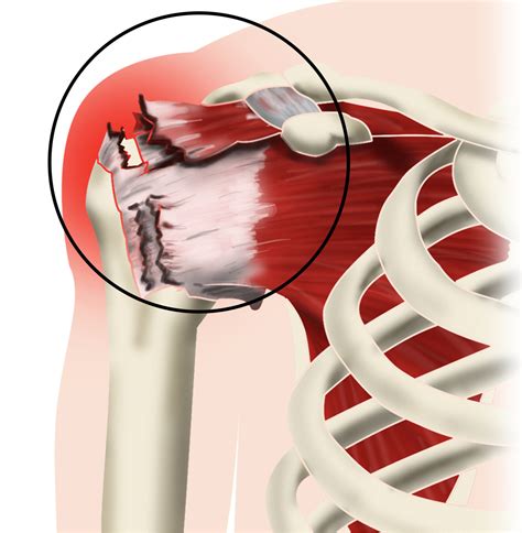 Rotator Cuff Tear Repair - Phoenix Spine & Joint