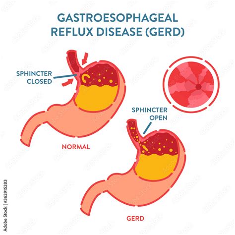 Gastroesophageal reflux disease diagnostics poster. Endoscopic image of stomach with GERD ...