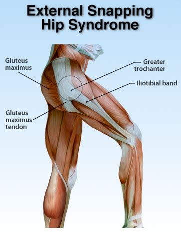 Snapping Hip Syndrome - Robert Howells