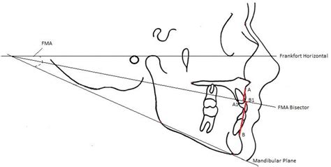 Figure 4 from An Evaluation of the Constructed Frankfort Mandibular ...