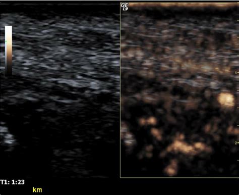 80 s after contrast agent injection, True Agent Detection ModeTM. Left:... | Download Scientific ...