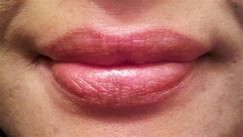 eczema on lip - pictures, photos