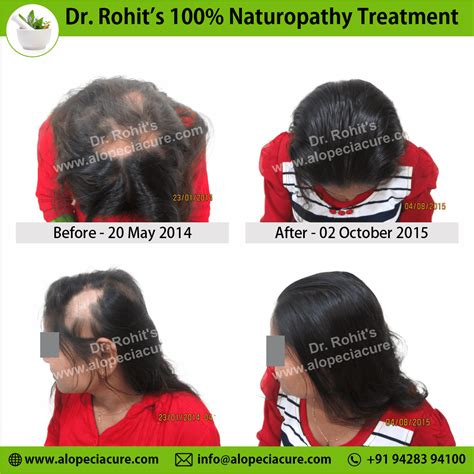 ophiasis alopecia areata treatment