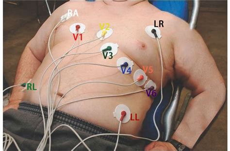 12 Leads ECG Placement tutorial and ECG cable choosing | YQF Medical ...