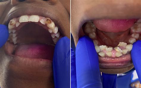 Dentist Reveals What 'Shark Teeth' Look Like As They Treat Orphaned Girl - Newsweek