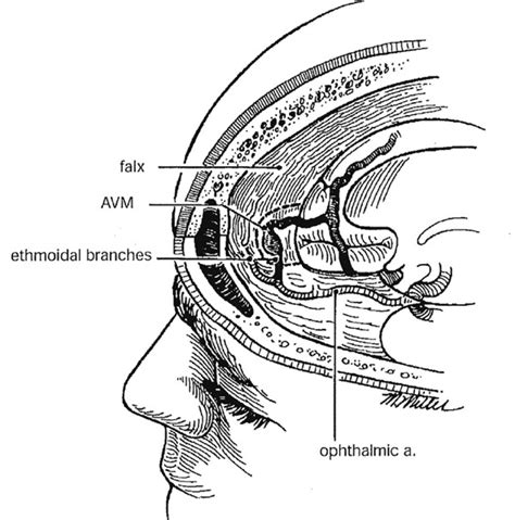 Anterior Fossa, Superior Sagittal Sinus, and Convexity Dural Arteriovenous Malformations ...