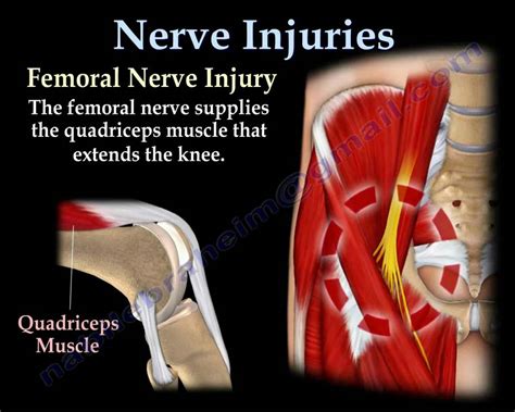 Injection Nerve Palsy Symptoms - mapasgmaes