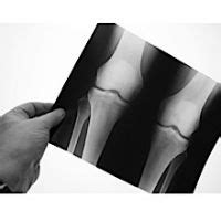 DePuy Knee Replacement Recall Lawsuit Information - Do I Qualify for a ...