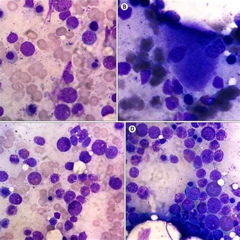 (PDF) A case of myelodysplastic syndrome with marked eosinophilia ...