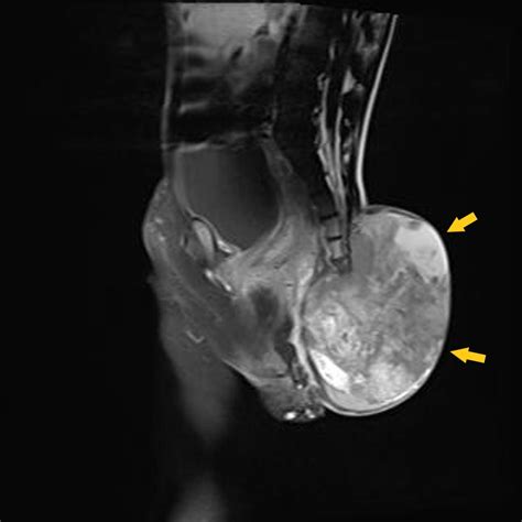 Sacrococcygeal teratoma MRI - wikidoc