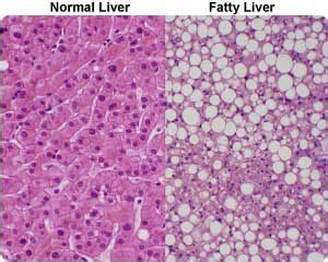 Hepatic Steatosis – Liver Basics