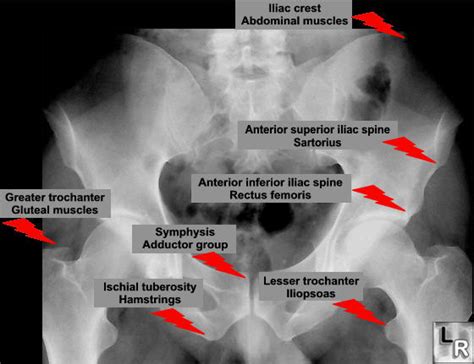 LearningRadiology - Pelvic, avulsion, fractures