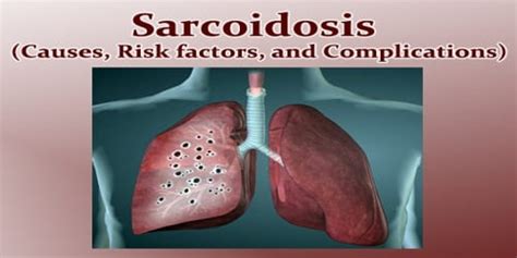 Sarcoidosis (Causes, Risk factors, and Complications) - Assignment Point