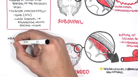 Intracranial Haemorrhage Types, signs and symptoms - YouTube