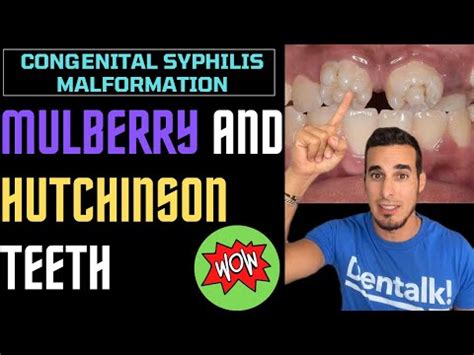 Hutchinson Teeth: Symptoms & Treatments