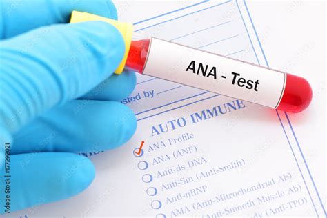 Blood sample for antinuclear antibody (ANA) test, autoimmune diagnosis ...