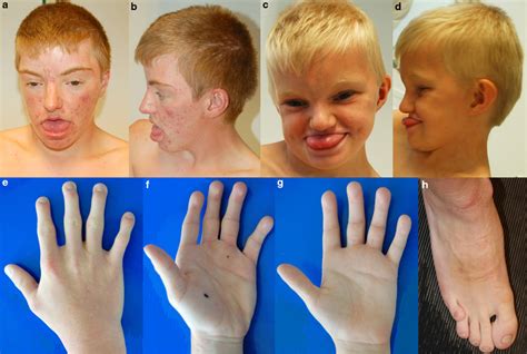 Facial photographs of patient 1 (a, b) and patient 2 (c, d) showing... | Download Scientific Diagram