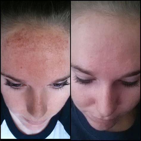 Ipl Face Treatment Before After - Doctor Heck