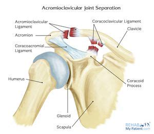 Acromioclavicular Joint Disorders - Physiopedia