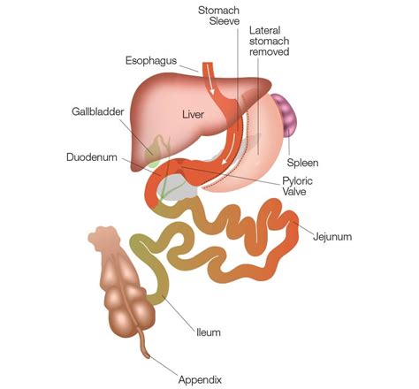 Laparoscopic-Sleeve-Gastrectomy-DS-Surgery - DSSurgery