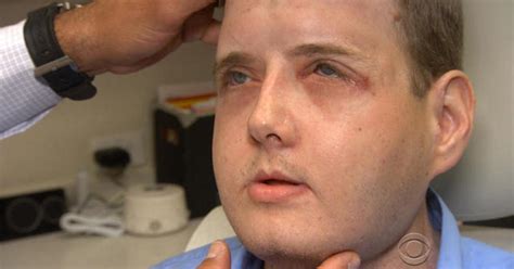 Face transplant recipient thriving one year after surgery - Videos ...