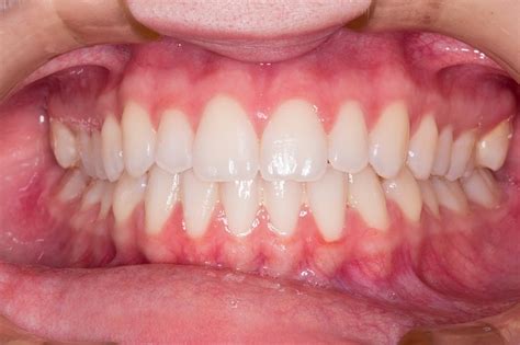 What are the types of gum disease treatment for gingivitis?