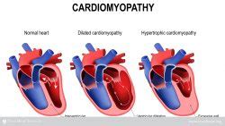 Cardiomyopathy | Texas Heart Institute