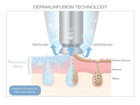 Dermalinfusion vs. Microdermabrasion - Dermatology Consultants